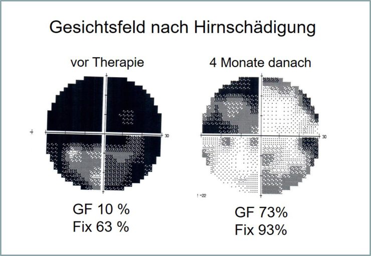 Gesichtsfeld des Patienten Sebastian A. vorher und nachher